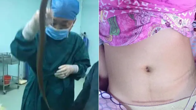 Nyaris Tewas, Demi Masturbasi Wanita Ini Masukkan Belut ke Vagina