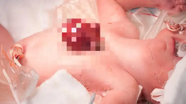 Organ Jantung Keluar Dari Tubuh, Bayi ini Tetap Selamat