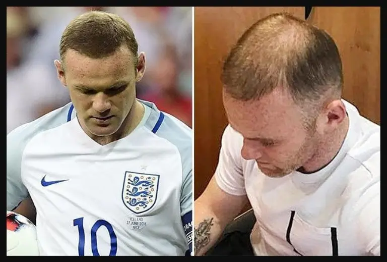 Kondisi terakhir rambut striker Everton, Wayne Rooney. (The Sun).
