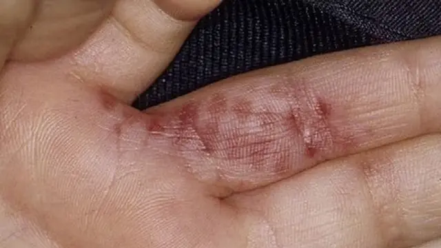 Ulat Bulu Asp