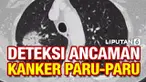 Di Amerika, kanker paru-paru membunuh lebih banyak orang dibanding kanker lain. Namun penelitian kanker paru-paru tidak mendapat perhatian sebesar kanker jenis lain. Namun panduan baru Pusat Pengendalian Penyakit AS merilis panduan baru yang mungkin ...