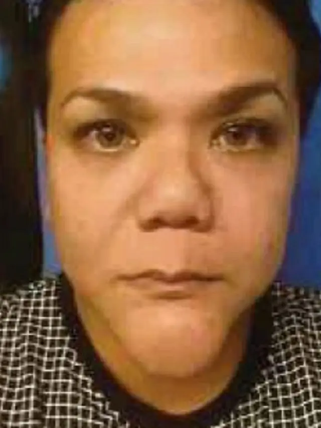 [Bintang] Ketagihan Suntik Kolagen, Hal Mengerikan Terjadi Pada Wanita Ini