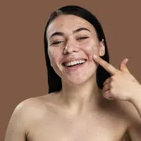 Potret perempuan tersenyum bangga menunjukan jerawatnya/copyright freepik.com/freepik