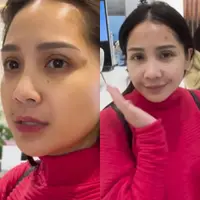 Wajah Bengkak Nagita Slavina Setelah Perawatan di Korea Selatan. [@raffinagita1717]