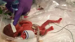 Foto pada Desember 2018, seorang bayi yang dipanggil dengan nama Saybie. Diyakini sebagai bayi terkecil yang pernah selamat dari kelahiran prematur, berat badan Saybie sama dengan sebuah apel besar ketika ia dilahirkan pada usia 23 minggu dan tiga hari Desember 2018 lalu. (HO/AFP/SHARP HEALTHCARE)