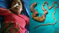 Dokter Angkat 150 Cm Rambut di Perut Remaja Ini
