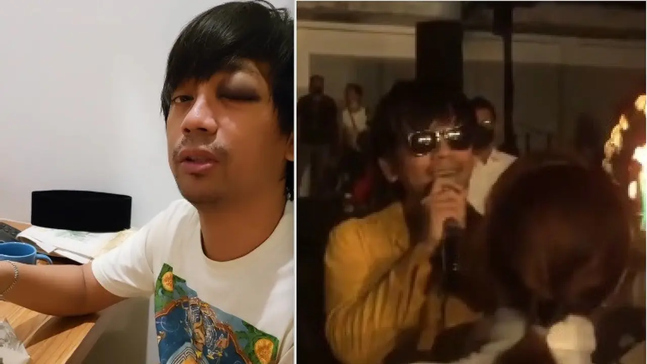 5 Potret Terkini Rian D'Masiv Usai Alami Kecelakaan, Mata Memar