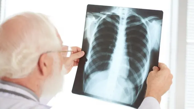 Ilustrasi pneumonia/freepik.com/ pressfoto