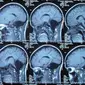 MRI pasien yang kehilangan otak kecil (Feng Yu et al)