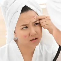 Ilustrasi jerawat. (c) serezniy/Depositphotos.com