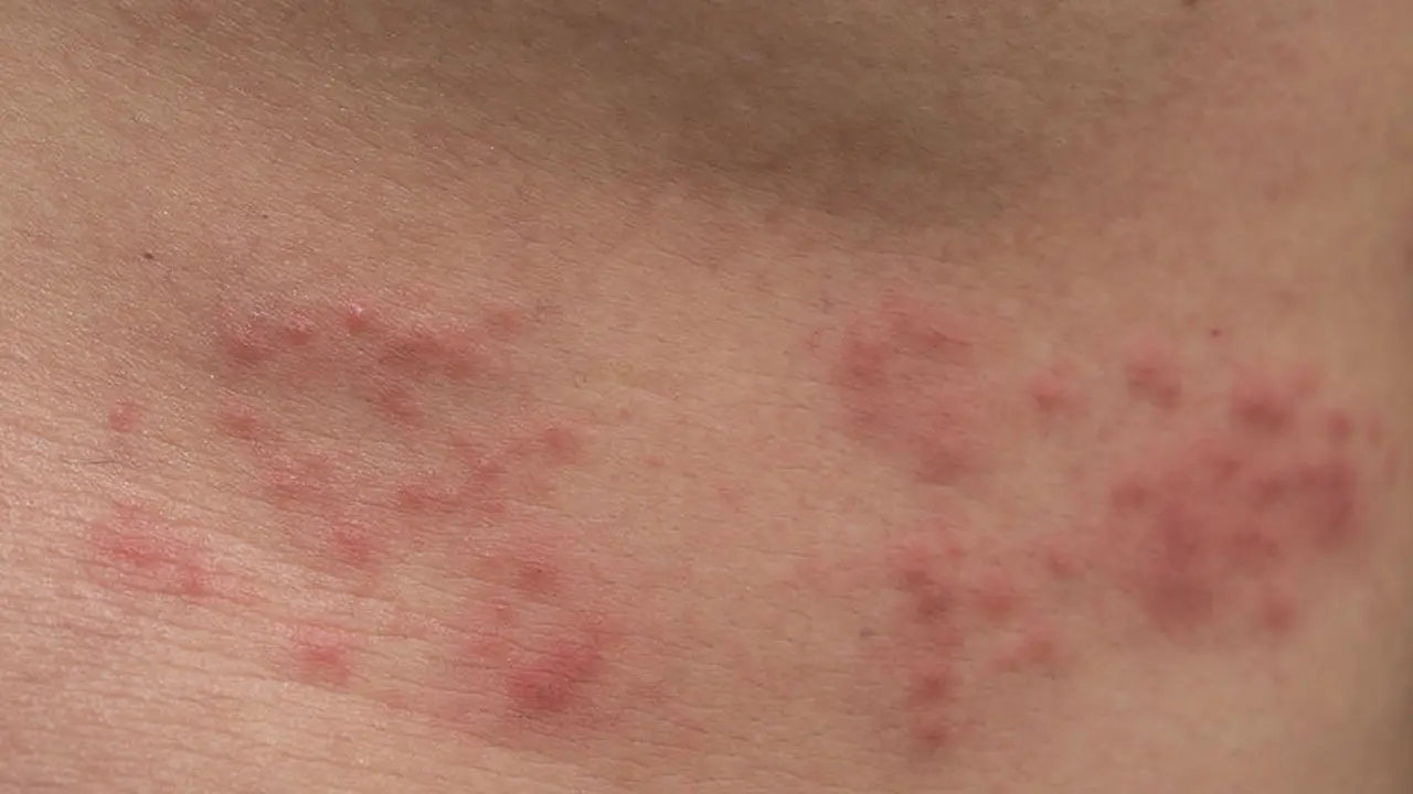Herpes Zoster