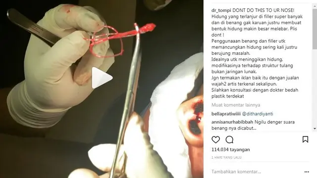 [Bintang] Berminat Tanam Benang? Coba Lihat Dulu Video yang Diunggah Oleh Dr Tompi Ini, Bikin Ngilu