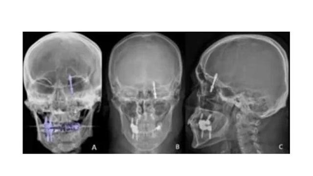 Beruntung, Pria Ini Tetap Hidup Usai Ditemukan Sekrup Implan Gigi Masuk ke Rongga Otak