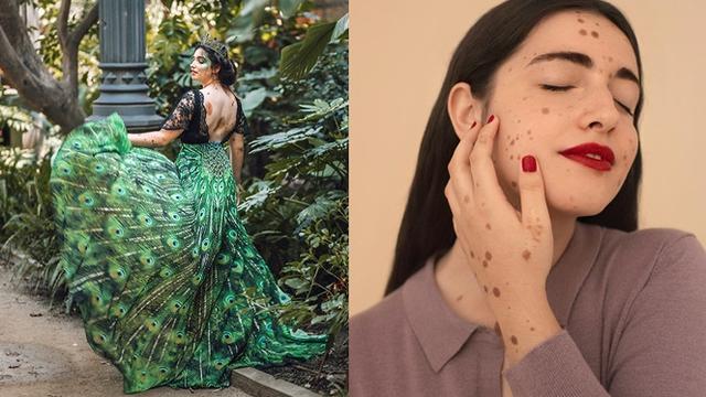 Alba Parejo, gadis yang punya 500 tanda lahir.