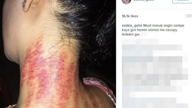 7 Potret Seleb Cantik Pamer Usai Kerokan Ini Tetap Menawan