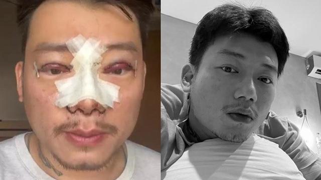 6 Potret Seleb Jalani Operasi Plastik di Tahun 2022, Penampilannya Bikin Pangling (sumber: Instagram/)