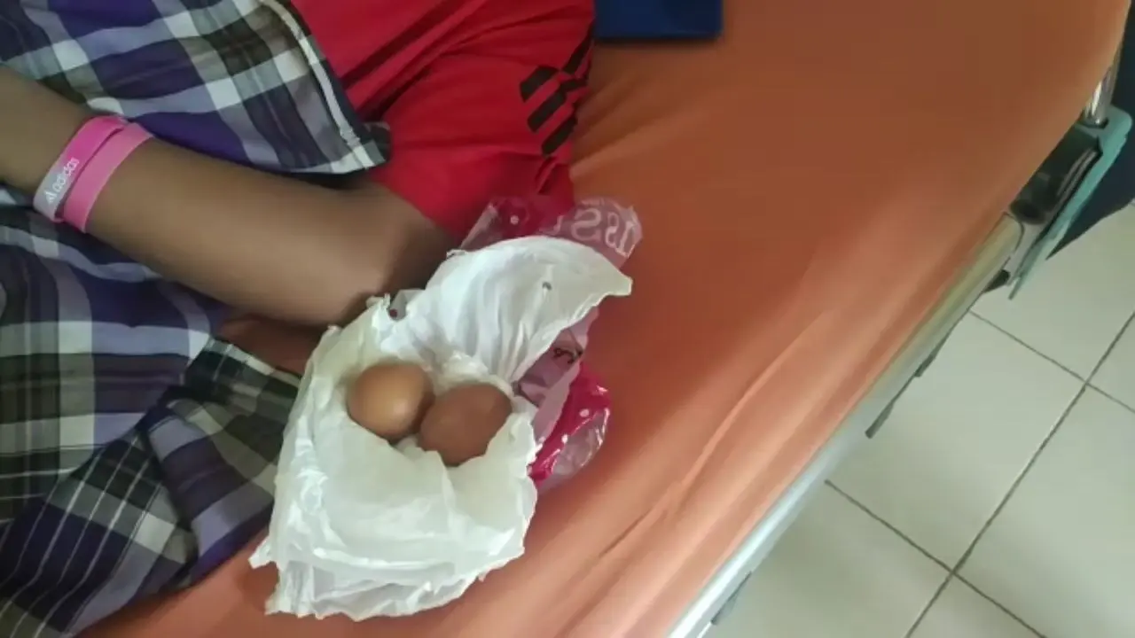 Total sudah 20 butir telur yang dikeluarkan dari dalam tubuh Akmal, remaja asal Gowa, dihitung dari kejadian pertama pada 2015. (Liputan6.com/Fauzan)