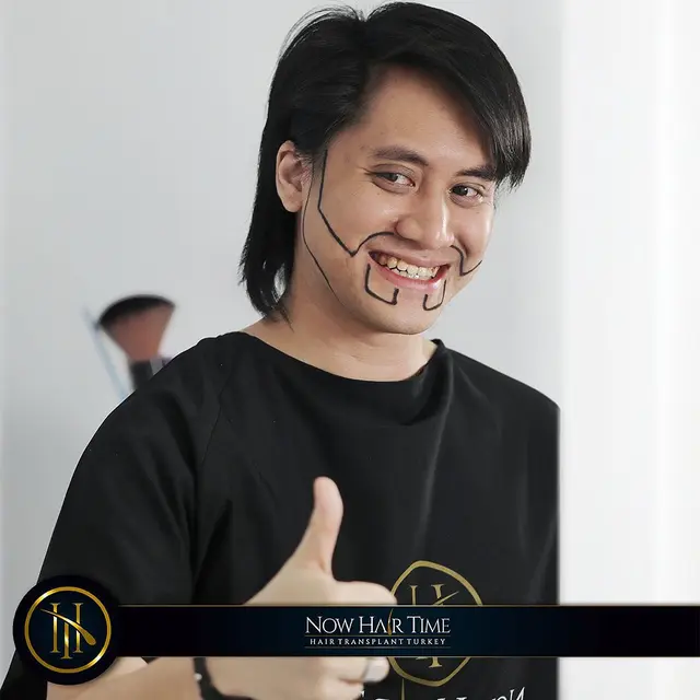 Potret Kevin Aprilio Jalani Transplantasi Rambut. (Sumber: Instagram/now.hairtime)