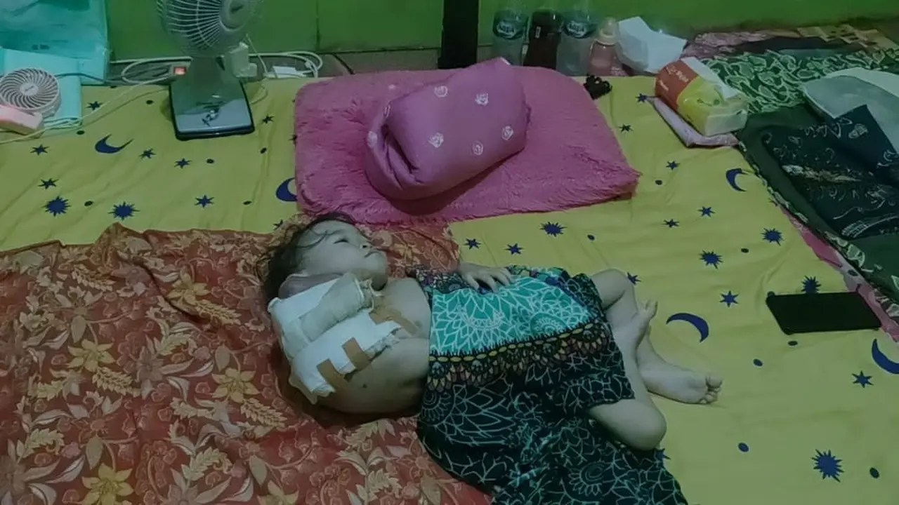 Balita mengidap tumor