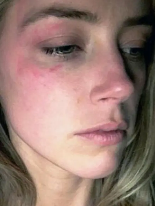 Tak hanya itu, Amber Heard melaporkan Johnny Depp yang diduga melakukan KDRT. Terlihat wajah Amber dipenuhi luka memerah dan lebam. (dailymail/Bintang.com)