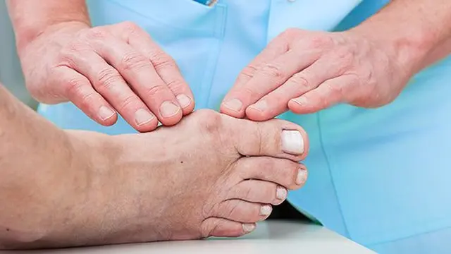 Ilustrasi Benjolan pada Jempol Kaki. (foto: Pinterest/psc).