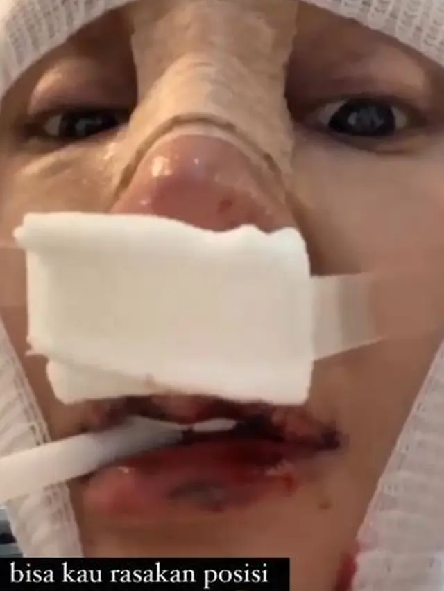 Jalani Operasi Potong Leher, Ini 6 Potret Kondisi Terbaru Lucinta Luna