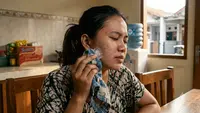 Apakah Es Batu Bisa Menghilangkan Jerawat? Ini Penjelasan Medisnya