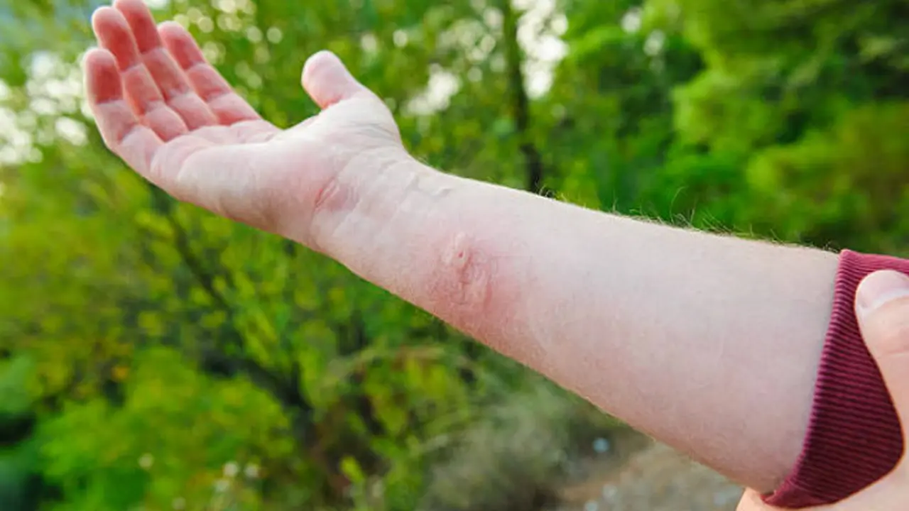 Gejala Penyakit Tetanus dan Penyebabnya, Kenali Sebelum Terlambat - Hot