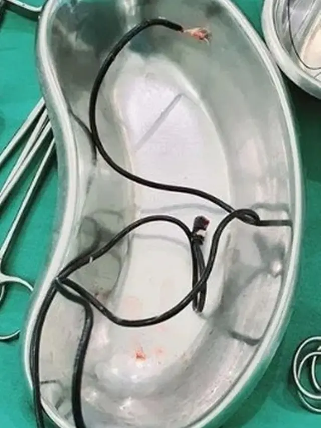 Kabel 60 Cm Ditemukan dalam Kandung Kemih Pria Ini, Buat Kepuasan Seksual?