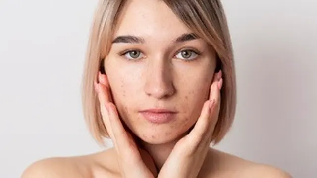 Bantu Hilangkan Jerawat