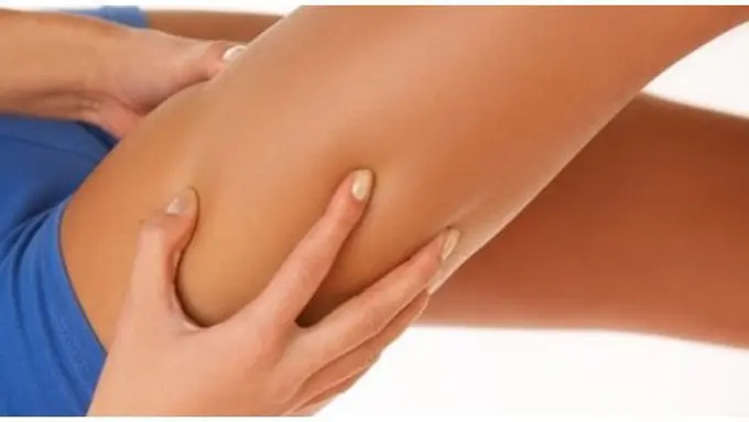 Selulit/copyright Shutterstock.com