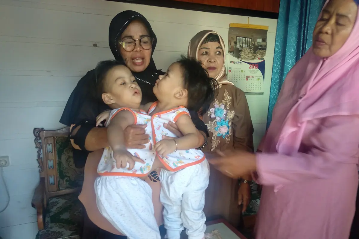 Bayi kembar siam Kendari, Aqila Dewi Sabila dan Azila Dewi Sabrina.(Liputan6.com/Ahmad Akbar Fua)