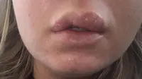Bibir seorang wanita Australia membengkak parah akibat luka bakar kimia setelah dia menggunakan kosmetik replika murahan 