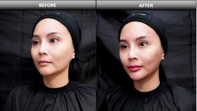 Before After Filler Restylane