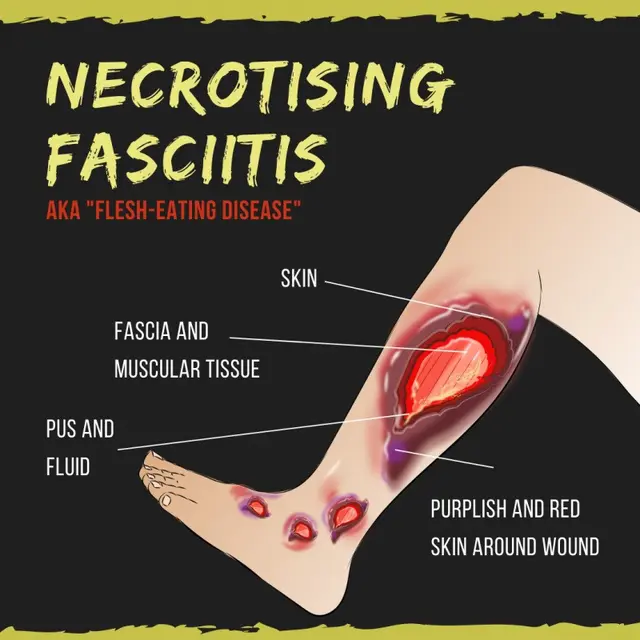Necrotising Fasciitis