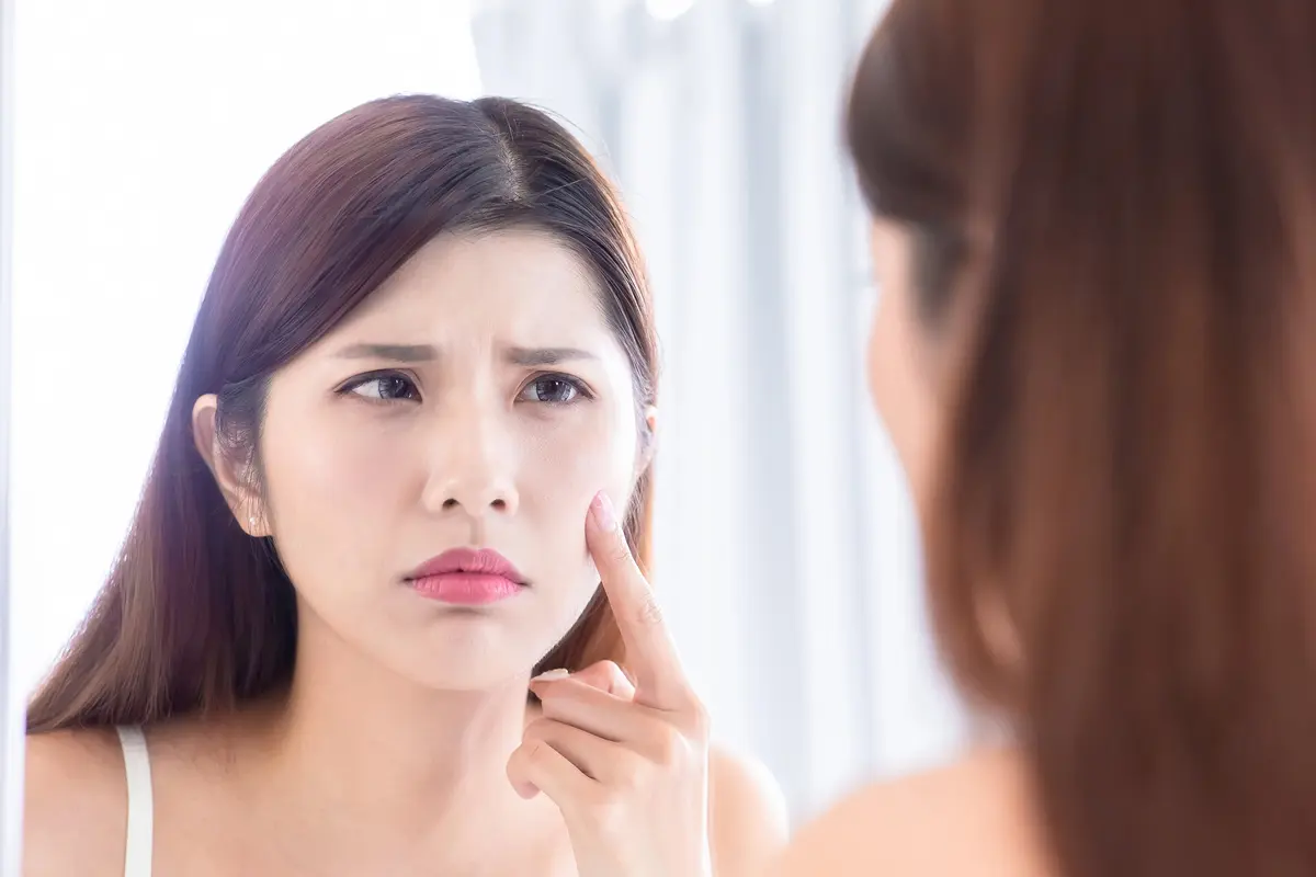 Bekas Jerawat Nggak Kunjung Pudar? Mungkin Ini yang Kulitmu Butuhkan