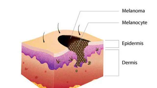 Melanoma 