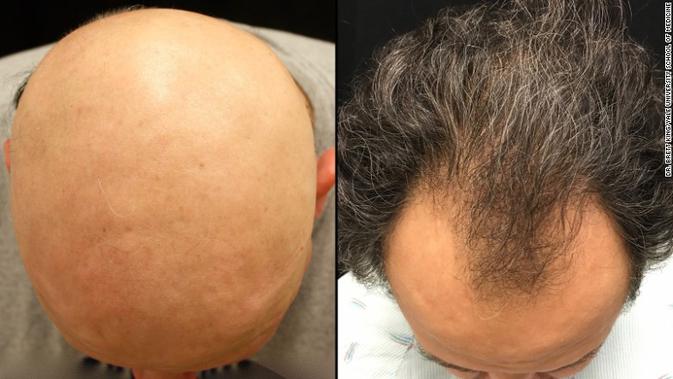 Pil Putih Ini Obat Mujarab Penumbuh Rambut Di Kepala Botak Global Liputan6 Com