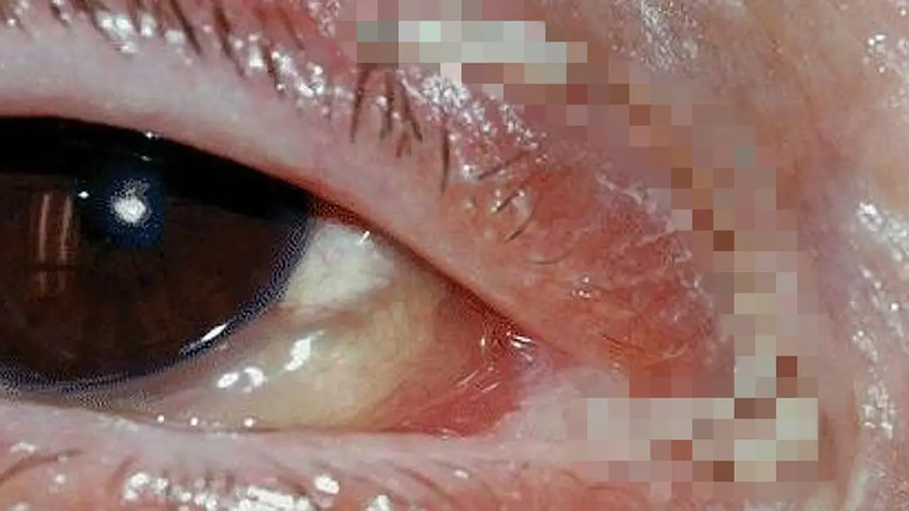 120 Belatung Hidup di Mata dan Hidung Nenek Ini
