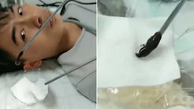 Mimisan Terus Menerus, Ternyata Ada Lintah Bersarang di Tubuh Pemuda Ini