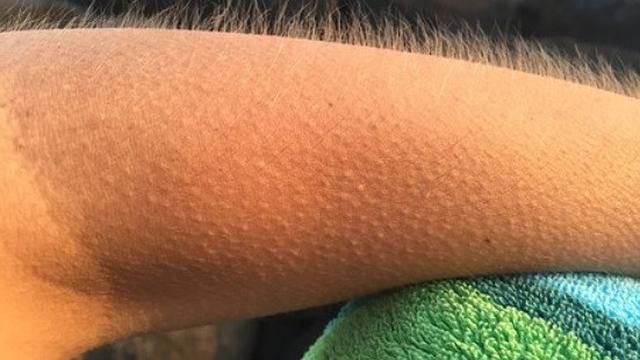 Ilustrasi Merinding (foto: Pixabay)