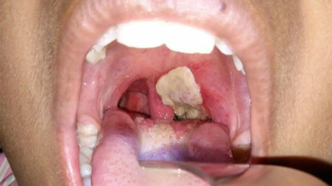 Disease (4)