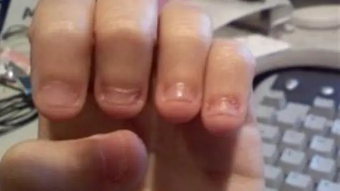 Penderitaan Hebat yang Dialami Kalau Kamu Masih Suka Gigitin Kuku