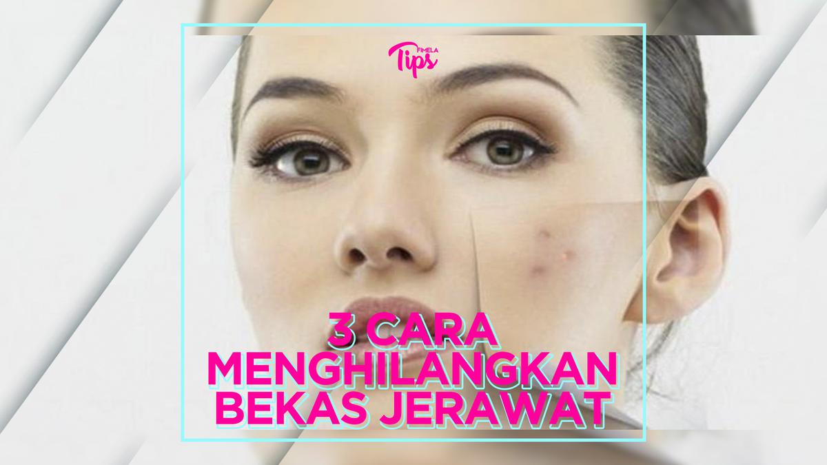 3 Cara Menghilangkan Bekas Jerawat Membandel - Lifestyle Fimela.com