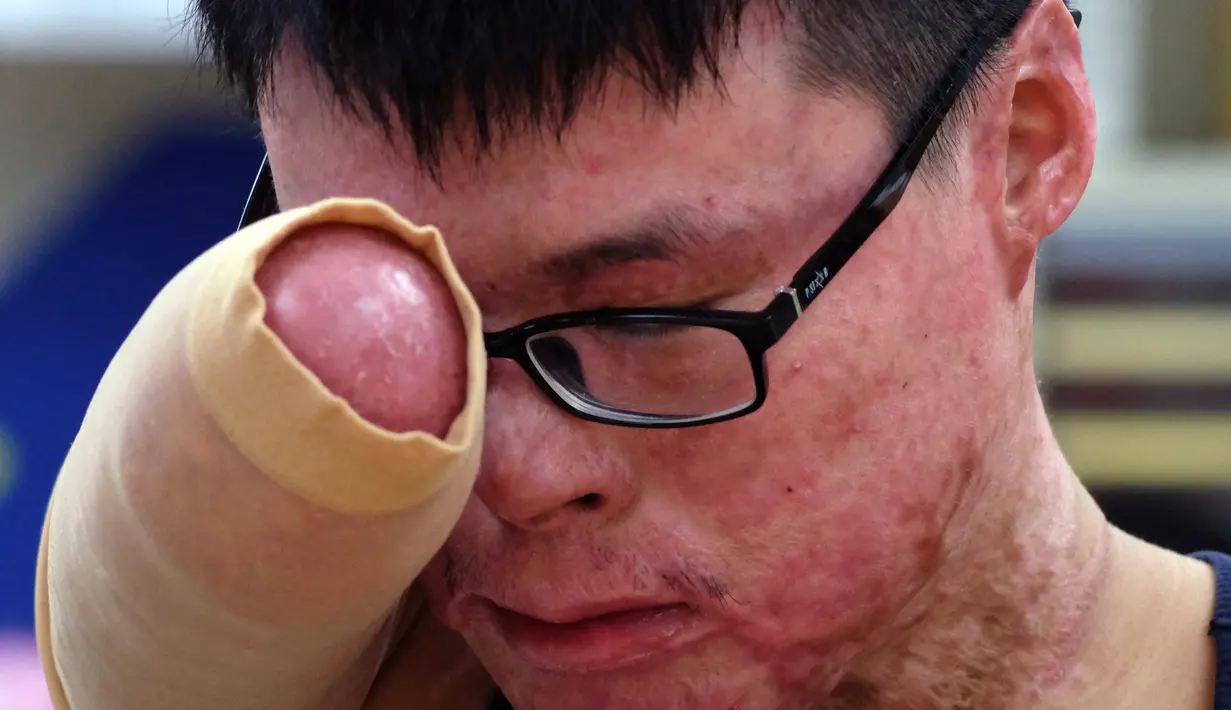 Huang Po - wei saat melakukan sesi rehabilitasi di pusat pemulihan di Taipe, Taiwan, (26/1/2016). Ia berlatih 5 kali seminggu untuk menggunakan kaki palsu agar dia bisa berjalan dan melupakan bencana yang terjadi setahun lamanya. (SAM YEH / AFP)