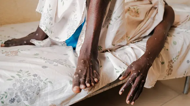 Mpox Clade 1 Menyebar di Afrika, Rasa Sakit Tak Tertahankan Menghantui