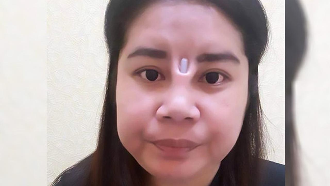 Bedah Hidung Agar Mancung, Wanita Ini Malah Alami Hal Mengerikan