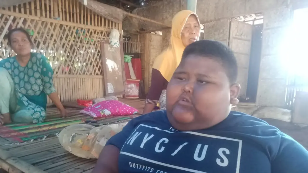Bocah Obesitas asal Karawang Meninggal Dunia