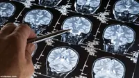 Gen Baru dan Mutasi Genetik Sebabkan Epilepsi Pada Anak