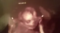 Tidak selamanya foto USG bayi yang diidam-idamkan terlihat menarik. Adakalanya, Anda justru mendapatkan sosok mengerikan